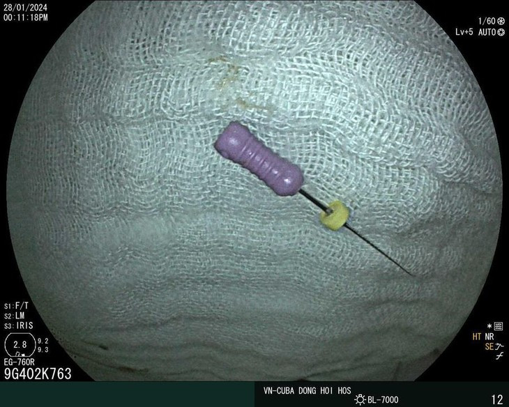 Be 5 tuoi nuot ca cay kim dai 2,5 cm vao bung-Hinh-2