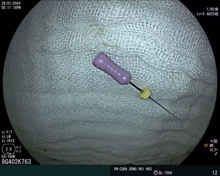 Be 5 tuoi nuot ca cay kim dai 2,5 cm vao bung-Hinh-2