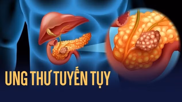 Cach phat hien som ung thu tuy sau trong o bung