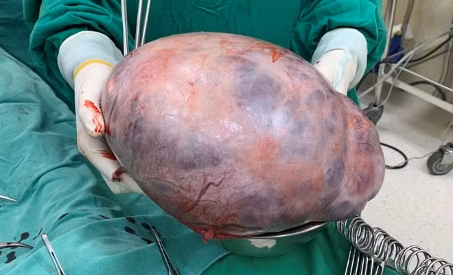 Tuong tang can do tam bo khong ngo... u buong trung ac tinh-Hinh-2