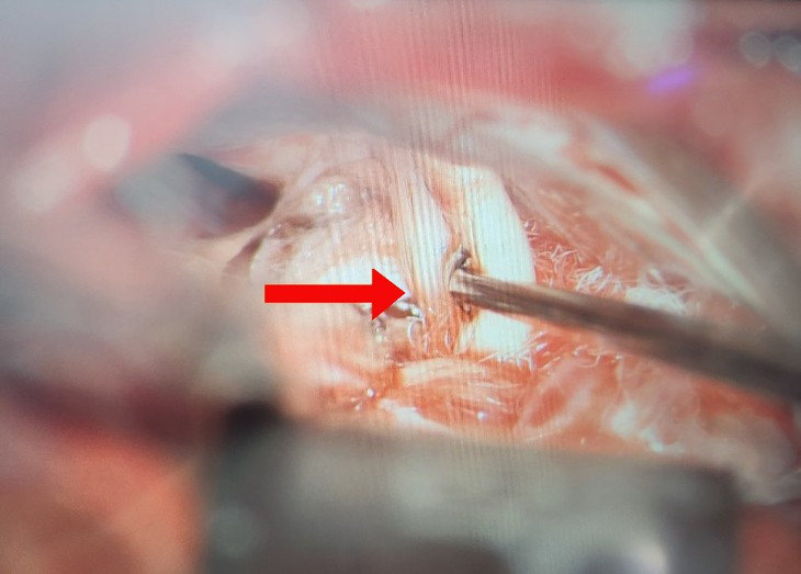 Dieu tri thanh cong cho ca benh mac chung co giat nua mat