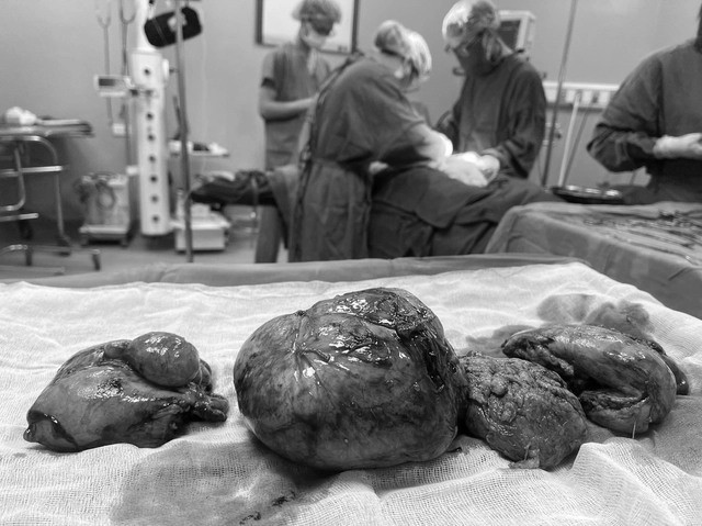 Nguoi phu nu co khoi u tu cung “khung“ nhu mang thai 6 thang