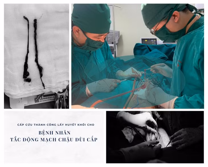 Dau chan, di kham phat hien tac dong mach chau dui cap