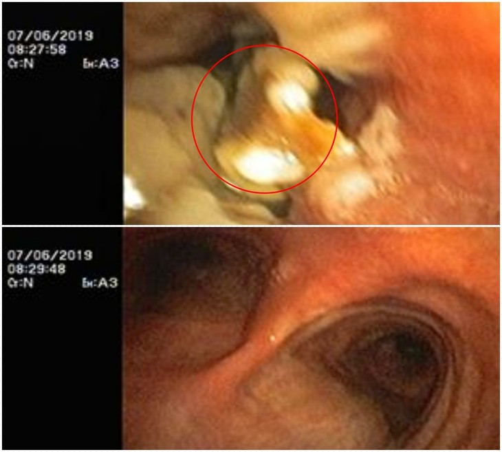 Dinh vit nhon lac trong phe quan nguoi dan ong 61 tuoi-Hinh-3