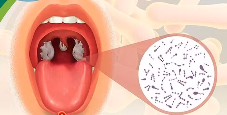 Phan biet benh bach hau hong voi cac chung viem hong, amidan