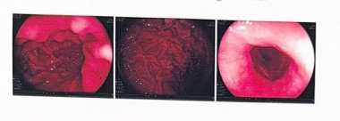 Nguoi dan ong mac 2 benh ung thu bat ngo voi ket qua xa tri