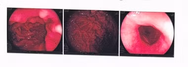 Nguoi dan ong mac 2 benh ung thu bat ngo voi ket qua xa tri