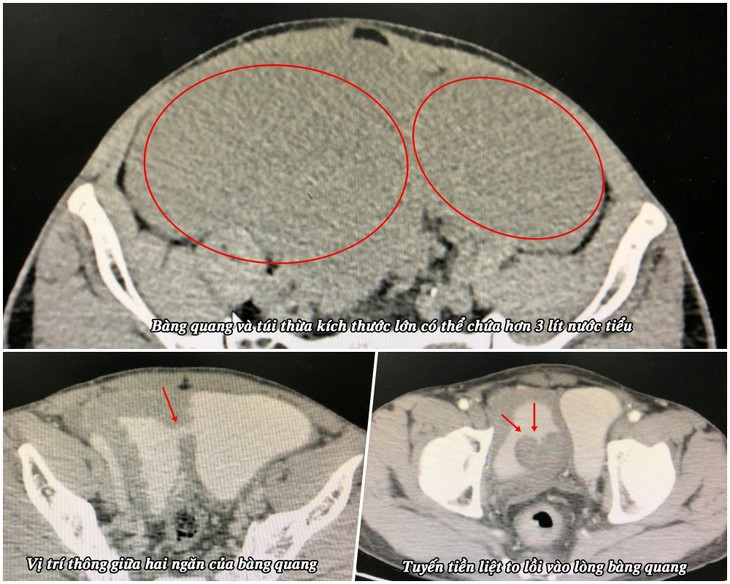 Benh nhan 58 tuoi co bang quang to gap 6 lan nguoi thuong-Hinh-2