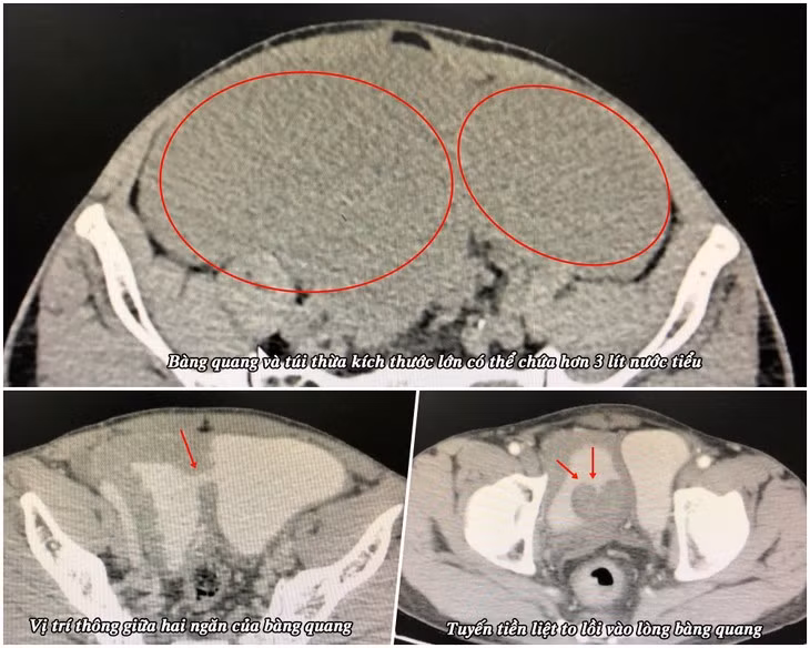 Benh nhan 58 tuoi co bang quang to gap 6 lan nguoi thuong-Hinh-2