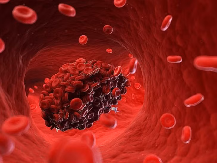 Dau hieu cua benh cuc mau dong va cach dieu tri