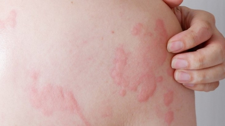 Di ung, may day co phai do suy giam chuc nang gan?