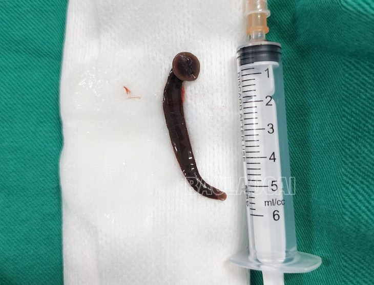 Đỉa sống dài hơn 5 cm nằm trong khí quản bệnh nhân 65 tuổi Dia song dai hon 5 cm nam trong khi quan benh nhan 65 tuoi