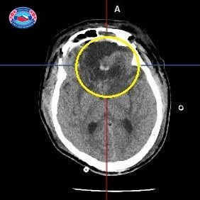 Thuc hien thanh cong ca phau thuat u mang nao kich thuoc khong lo