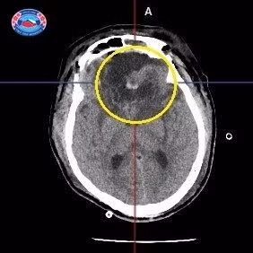 Thuc hien thanh cong ca phau thuat u mang nao kich thuoc khong lo