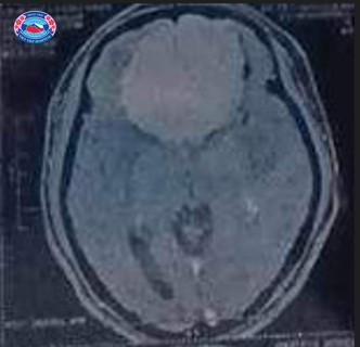 Thuc hien thanh cong ca phau thuat u mang nao kich thuoc khong lo-Hinh-2