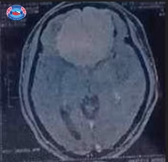 Thuc hien thanh cong ca phau thuat u mang nao kich thuoc khong lo-Hinh-2