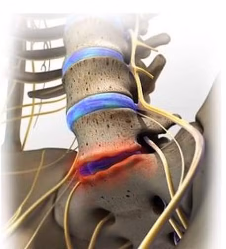 Chuyen gia mach dau hieu benh thoai hoa dia dem cot song that lung-Hinh-2