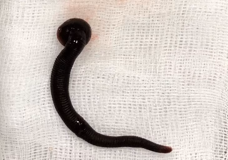 Gap con vat dai 5cm trong duong ho hap cua thai phu 21 tuoi-Hinh-2