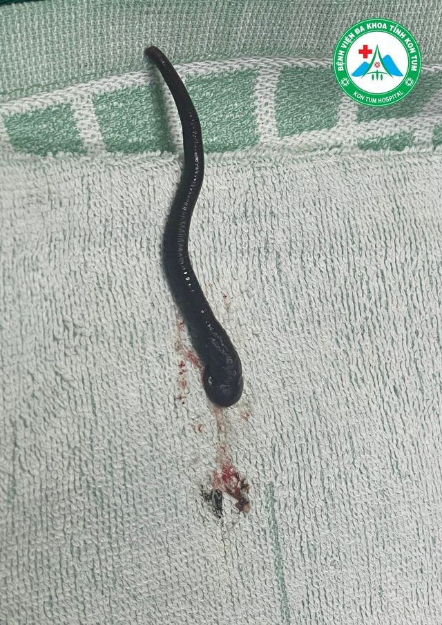 Kinh hai vat dai 7cm song trong xoang mui nu benh nhan