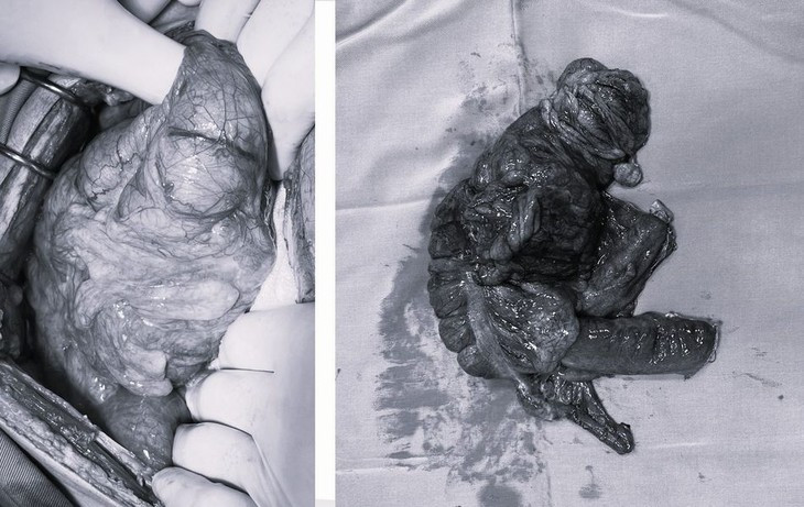 Nam benh nhan 30 tuoi bi tac ruot do u dai trang-Hinh-2