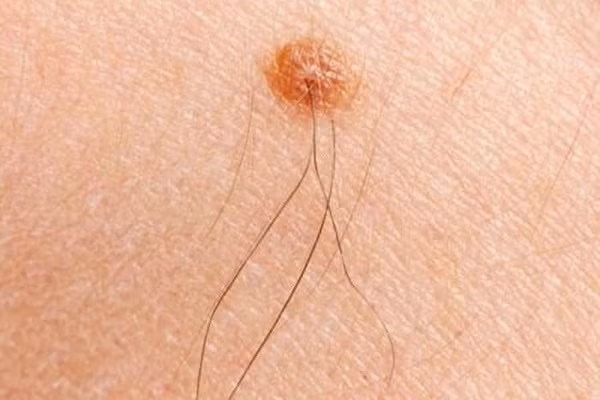 Cho nên, nếu chỉ có một sợi lông mọc trên nốt ruồi thì chưa chắc đã mang tới nhiều tài lộc cho người sở hữu nó. Ngược lại, nếu lông mọc trên nốt ruồi càng nhiều thì người đó có tài vận càng tốt.