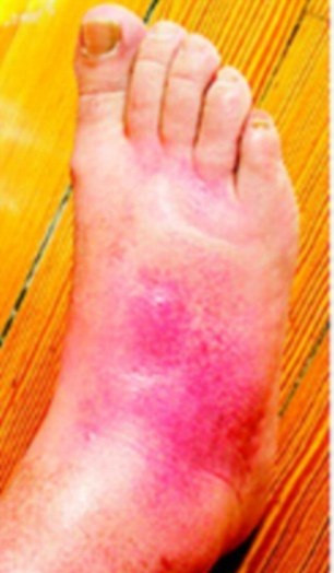 Ban đầu chỉ là một vết xây xát nhỏ màu đỏ.