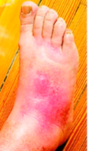 Ban đầu chỉ là một vết xây xát nhỏ màu đỏ.