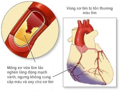 Bệnh tiểu đường còn gây ra các biến chứng nguy hiểm về các mạch máu và tim.