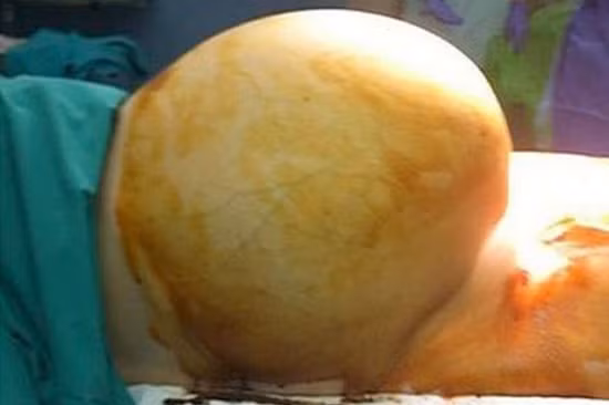 Tổng chiều dài khối u lên tới 41cm, kéo dài từ xương mu tới xương ức trong bụng bệnh nhân.