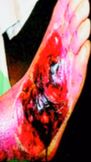 Và 10 ngày sau, vết thương phát triển thành một vết lở loét nghiêm trọng, cần phải thực hiện phẫu thuật nhanh chóng.