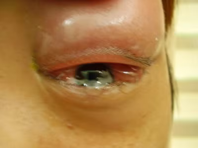 Đường huyết cao khiến mạch máu nhỏ tại võng mạc bị nghẽn, có thể bị vỡ gây tấy đỏ, sưng ứ gây ra tổn thương mắt và các bệnh võng mạc.