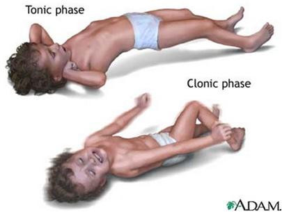 Nghiên cứu trên 23 trẻ em bị bệnh động kinh cho thấy hạt dầu đen làm giảm tần suất co giật.