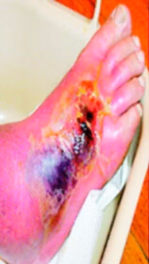 6 ngày sau, nó trở thành một vết áp xe (tụ mủ cục bộ).