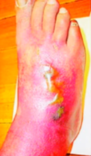 Chỉ ba ngày sau, vết đỏ đã phồng rộp lên