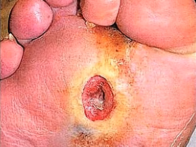 Tiểu đường có rất nhiều biến chứng nguy hiểm, như tổn thương thần kinh ngoại vi dẫn đến nhiễm trùng, hoại tử, gây loét và có thể phải cắt cụt chi để bảo toàn tính mạng.