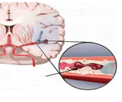 Huyết ứ gât thiếu máu não