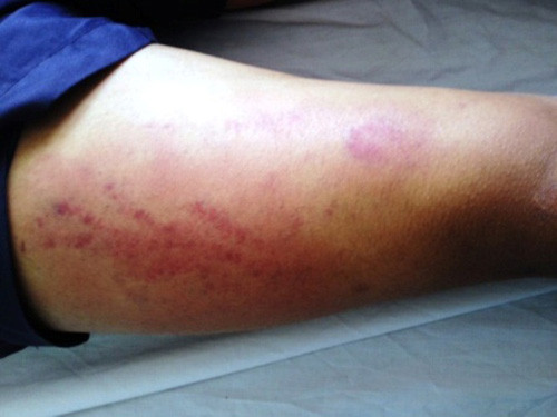 ... đùi có nhiều vết tụ máu bầm.