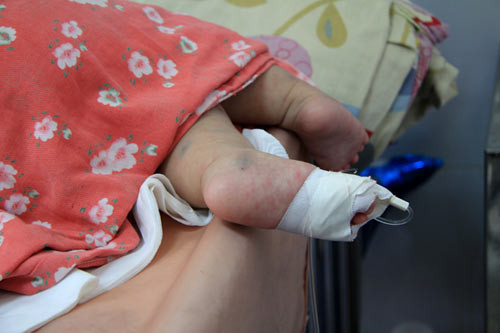 Với trẻ em, khi trẻ mắc bệnh mà chưa nhiễm sởi các mẹ nên tránh đưa con tới các bệnh viện là tâm điểm của dịch để phòng ngừa con bị lây nhiễm chéo theo bệnh sởi, dẫn tới những biến chứng nặng nghiêm trọng hơn. Thay vì vậy các mẹ hãy đưa con tới bệnh viện cấp dưới vì ở đó hoàn toàn có thể điều trị sởi.