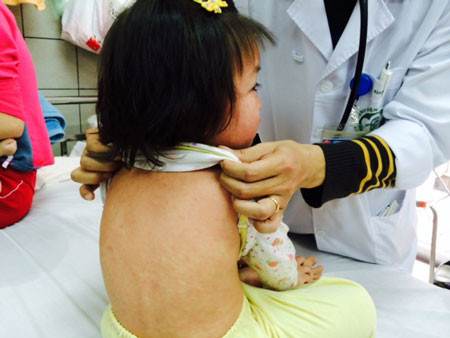 Khi bị bệnh sởi, người bệnh cần được đưa đến gặp bác sỹ ngay để chẩn đoán và điều trị kịp thời. Ngoài ra, người bệnh cần được nghỉ ngơi tối đa, uống thật nhiều nước lọc, nước trái cây, trà thảo dược (vì khi sốt cơ thể sẽ mất nhiều nước), giảm thiểu hoạt động mắt (đeo kính đen, tránh đọc sách và tiếp xúc máy tính hay ti vi).