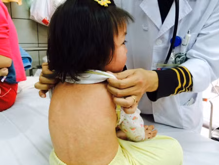 Khi bị bệnh sởi, người bệnh cần được đưa đến gặp bác sỹ ngay để chẩn đoán và điều trị kịp thời. Ngoài ra, người bệnh cần được nghỉ ngơi tối đa, uống thật nhiều nước lọc, nước trái cây, trà thảo dược (vì khi sốt cơ thể sẽ mất nhiều nước), giảm thiểu hoạt động mắt (đeo kính đen, tránh đọc sách và tiếp xúc máy tính hay ti vi).