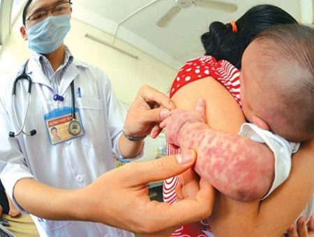 Dịch sởi đang diễn biến vô cùng phức tạp.