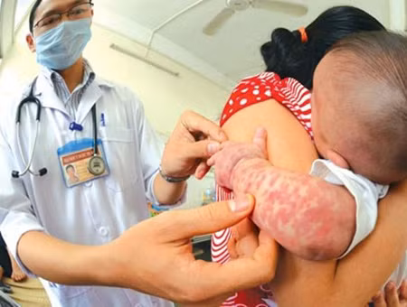 Dịch sởi đang diễn biến vô cùng phức tạp.
