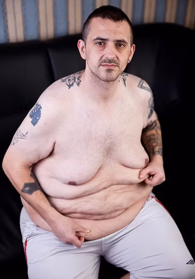 Anh Jason Young, 29 tuổi, sống ở Nottingham, nước Anh đã giảm từ gần 197kg xuống còn 114kg sau khi trải qua ca phẫu thuật thắt dạ dày với chi phí 10.000 Bảng. Do trọng lượng giảm đột ngột nên da dư thừa của anh lên tới 22kg.