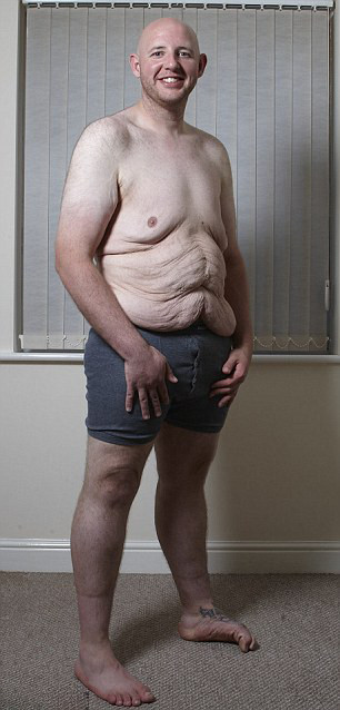 Da bụng nhăn nheo, dúm dó do giảm cân bằng phương pháp cắt dạ dày.