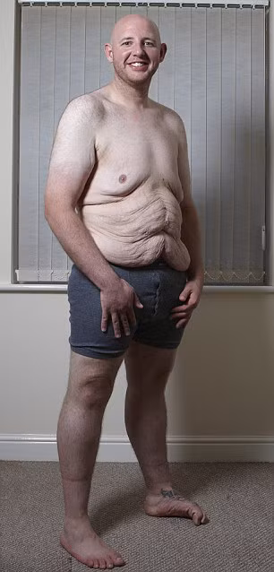 Da bụng nhăn nheo, dúm dó do giảm cân bằng phương pháp cắt dạ dày.