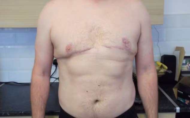 Sau khi phẫu thuật cắt bỏ mô mỡ ở ngực, dù anh đã tự tin với cơ thể mình nhưng các thủ thuật thẩm mỹ đã bị lỗi, khiến cho anh chỉ còn một bên núm vú.