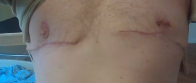 Dù một bên núm vú của anh này bị biến dạng do lỗi phẫu thuật, nhưng anh cảm thấy điều quan trọng là anh đã loại bỏ được yếu tố không cần thiết ra khỏi cơ thể mình.