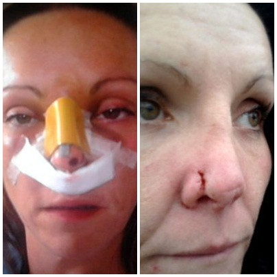 Mũi cô Nugent chấn thương và đau đớn nghiêm trọng.