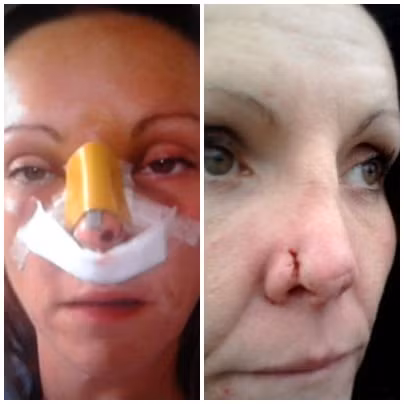 Mũi cô Nugent chấn thương và đau đớn nghiêm trọng.