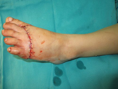 Kỹ thuật vi phẫu sử dụng kính hiển vi có độ phóng đại nhiều lần sẽ giúp BS khâu nối chính xác các bó sợi thần kinh và nối được các mạch máu nhỏ.